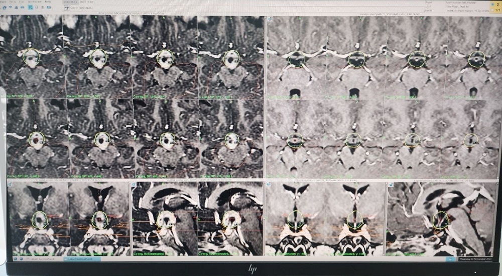 معالجة ورم الدماغ باشعة كاما 