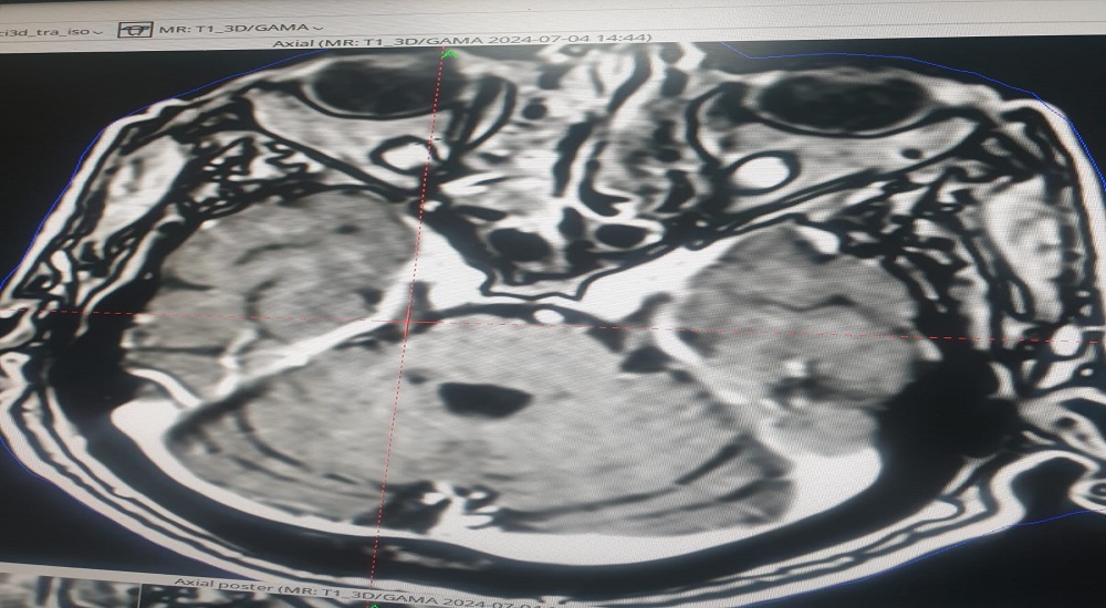 ورم العصب الخامس يتم علاجه باشعة كاما