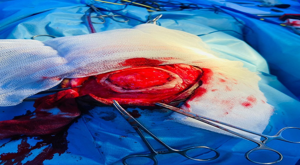 عملية وضع شبكة لترميم جمجمه