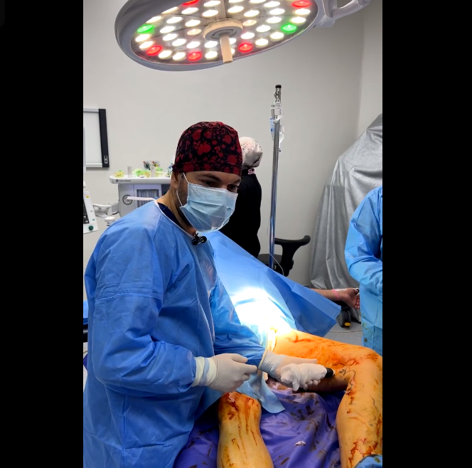 عملية رفع دوالي الساق اليسرى