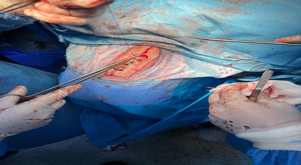 عملية رفع ورم دماغي لطفل عمره 12 سنة